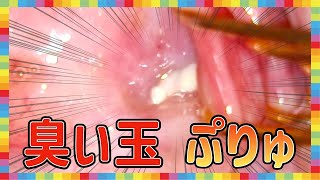 【臭い玉たっぷり】エアーで奥の奥まで見えたかくれた臭い玉を見つけました／Tonsil stones [upl. by Enerod]