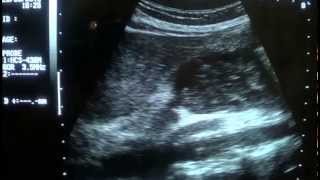 HEMORRAGHIC PANCREATITIS ultrasound [upl. by Ahsemrac948]