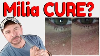 How To Get Rid Of Milia  Hard White Bumps on Face and Eyes  Chris Gibson [upl. by Yeltnarb738]