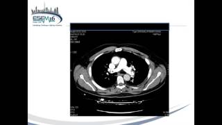 Pulmoner Emboli [upl. by Odranreb]