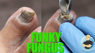 HAVE NAIL FUNGUS YOU NEED TO BE DOING THIS SUPER IMPORTANT TIP [upl. by Esinwahs]