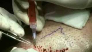 Hair Transplant Repair CIT plug removal session  Video By Dr Cole [upl. by Ariem]