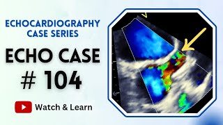 ECHO Case 104  Echocardiography for Beginners  Fever in a Child [upl. by Kcered]