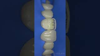 Composite restoration toothbuilup dentalcaries dentist dentalfillingorthodontist healthysmile [upl. by Dnalrah]