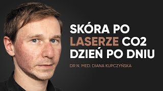 Laser CO2 na blizny  rekonwalescencja dzień po dniu [upl. by Anawit]