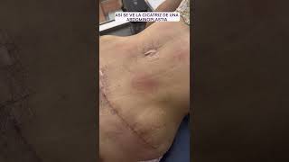 Cicatriz de una abdominoplastia  Dra lina Franco cirugiasplasticas [upl. by Enniroc]