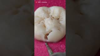 Clean Tooth or Cavity Tooth Must Watch toothrestoration dentist [upl. by Gans]