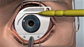 LASIK eye surgery  3D animation [upl. by Katushka]