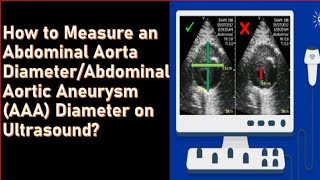 How to measure abdominal aortic aneurysm on Ultrasound [upl. by Enamrahs570]