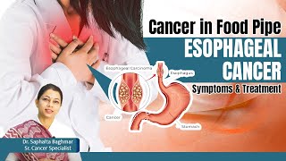 Treatment for Cancer in Food Pipe  ✅Esophageal Cancer Risk Factors Symptoms and Treatment in Hindi [upl. by Aleahpar468]