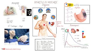 INFARCTUS DU MYOCARDE IDM  PHYSIOPATHOLOGIE ET DIAGNOSTIC [upl. by Raknahs]