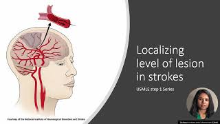 USMLE Step 1 Pathology  Localizing level of lesion in strokes [upl. by Ruomyes]