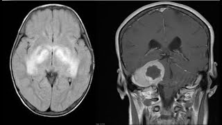 15CNSneuroradiologySpotterscasesradiopediaMRICTXrayangiographyquizzesfrcrexamsbesttip [upl. by Middleton]