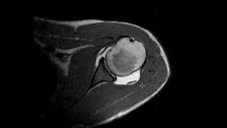 Labral tear in 20 year old [upl. by Thrift192]