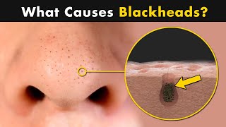 What Causes Blackheads on Our Skin  Symptoms Causes And Treatment [upl. by Suisyola]