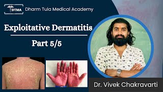 Dermatitis  Exfoliative Dermatitis Hindi  Types  Part 55 Eczema  Skin Disease  Skin Infection [upl. by Ethelda]