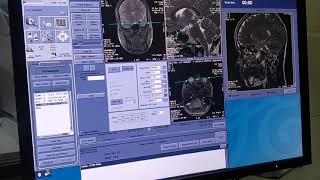 MRI CSF FLOW STUDY [upl. by Irama]