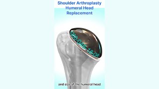 Shoulder Hemiarthroplasty  Humeral head replacement [upl. by Murphy]