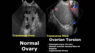 Ovary Ultrasound Normal Vs Abnormal Image Appearances  Ovarian Pathologies On USG [upl. by Urban]