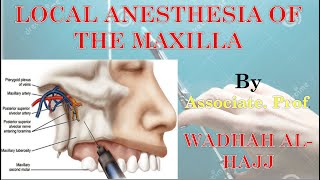 4 Local anesthesia of the maxilla – Dr Wadhah local anesthesia lectures د وضاح الحاج [upl. by Mcclees797]