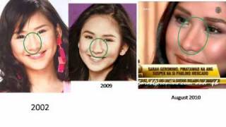 Sarah Geronimo Nose Job [upl. by Hughett]