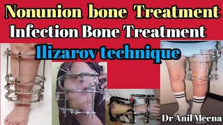 ilizarov technique  non union fracture treatment  bone infection fracture treatment  in hindi [upl. by Garwin622]