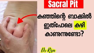 കുഞ്ഞുങ്ങളുടെ പുറകിൽ കുഴിപോലെ ഉണ്ടോ Sacral Pit Malayalam Baby Care Tips [upl. by Lesak33]