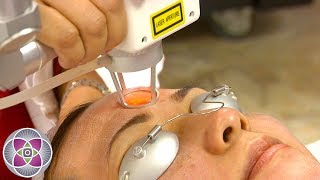 What is Fractional Co2 Laser Resurfacing [upl. by Osrock136]