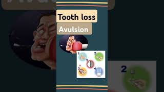 Tooth loss Avulsion [upl. by Kiyoshi]