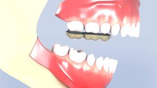 How Class III Malocclusion Corrected using Reverse Pull Headgear [upl. by Anod432]