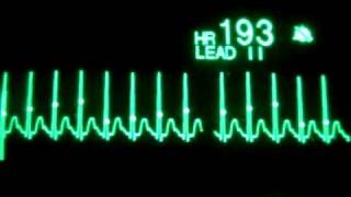 Taquicardia supraventricular con cardioversión sincronizada AS [upl. by Bonar]