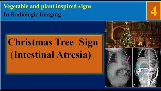 Christmas Tree Sign  Applepeel Intestinal Atresia [upl. by Ydiarf947]