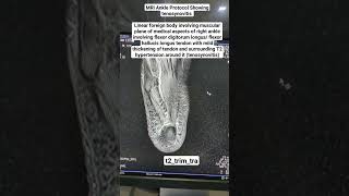 MRI Ankle Showing tenosynovitis in t2trimtra Sequence beginners [upl. by Seugram]