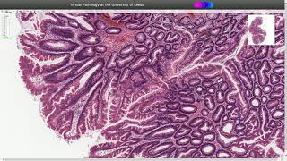 Traditional Serrated Adenoma  Histopathology [upl. by Jun329]