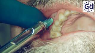 Infiltration Anesthesia for treatment tooth 24 [upl. by Nohsram]