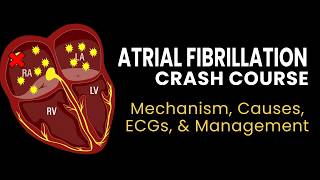 AFib Crash Course Mechanism ECG Causes amp Management [upl. by Kaule]