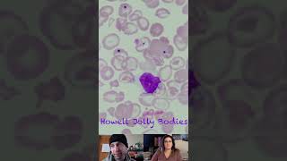 Howell Jolly Bodies vs Pappenheimer Bodies vs Basophilic Stippling [upl. by Onileba]