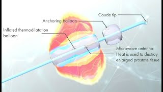 PROLIEVE® THERMODILATATION [upl. by Dlabihcra332]