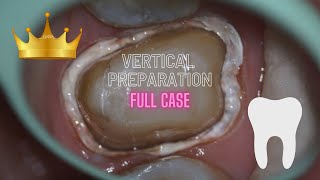 VERTICAL PREPARATION Full case Zirconia Crown [upl. by Haelak]