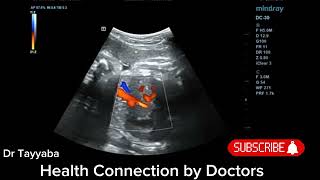 USG Ductus Venosus Doppler At 34 Weeks of Pregnancy  Health Connection by Doctors [upl. by Reo]