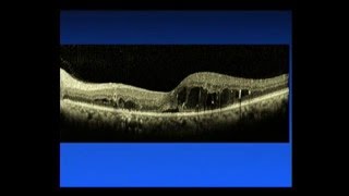 Diabetic Macular Edema  Saving Sight 2014 [upl. by Kantor280]