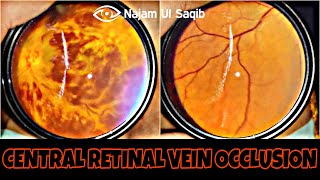 Central Retinal Vein Occlusion CRVO [upl. by Copeland942]