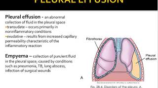 pleural eff pleurisy atelectasis [upl. by Ained]