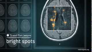 Multiple Sclerosis Understanding Your MRI [upl. by Raffaello]