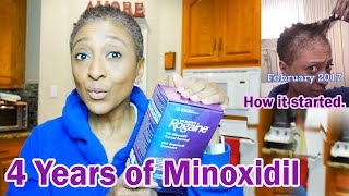 UPDATE  Minoxidil  4 YEARS LATER  TV Blake Review [upl. by Reehsab]