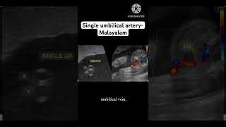 Single umbilical artery l എന്താണ് സിംഗിൾ umbilical artery SUA malayalam [upl. by Odlanir]