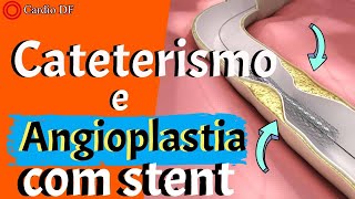 CATETERISMO e ANGIOPLASTIA COM STENT saiba tudo 2021 [upl. by Edlyn]