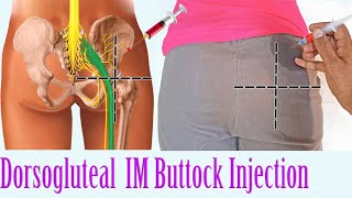 IntramuscularIMinjection Techniques in gluteal muscle youtube study [upl. by Atinaj242]