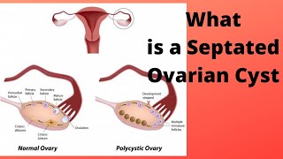 What is a Septated Ovarian Cyst [upl. by Tesler363]