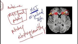 Video 217 Overview of Demyelinating Disorders Clinical Features Diagnostics and Risk Factors [upl. by Ewer]